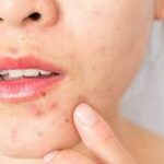 What are causes of pimples