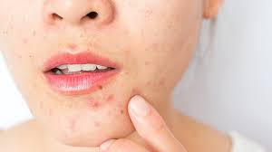 What are causes of pimples