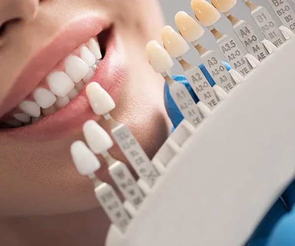 Top Reasons to Choose Dental Crowns in Vancouver for a Perfect Smile
